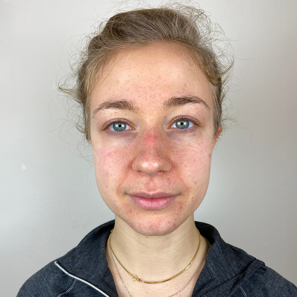 Sofia Resultate Skin Clear Young ölige T-zone Before